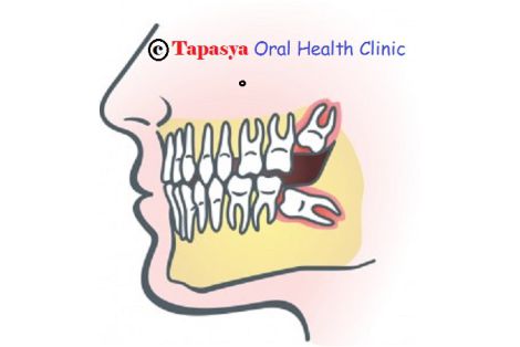 Painful Wisdom Tooth removal-Tapasya Clinic